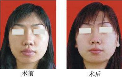 沈陽做隆鼻手術(shù)哪家醫(yī)院效果好