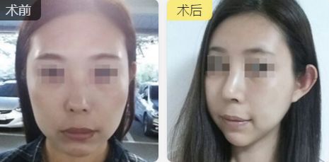 合肥雙眼皮整形推薦：口碑好、技術(shù)精湛、性?xún)r(jià)比高的醫(yī)生