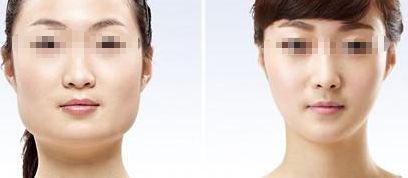 咸陽哪家醫(yī)院做雙眼皮好？醫(yī)院推薦！