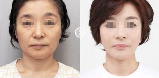 蘇州奧克拉醫(yī)院的整形效果及評價如何？