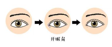 如何選擇適合自己的雙眼皮手術方法？