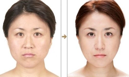 上海美聯(lián)臣吸脂怎么樣？真實(shí)案例告訴你答案！
