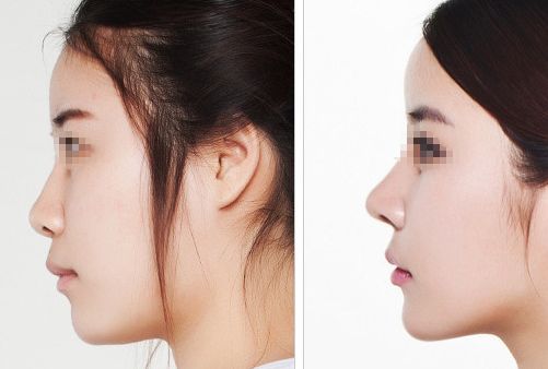 汕頭名流整形醫(yī)院：拉雙眼皮、吸脂價格一覽，專家解讀真實案例