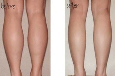 無(wú)錫溶脂針瘦肚子醫(yī)生