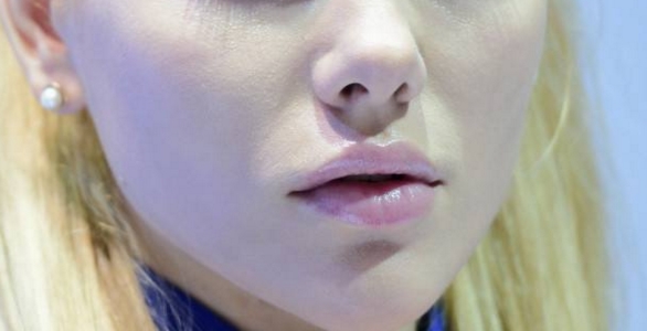 日照小切口去皺紋醫(yī)生