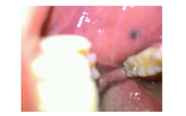 寧波飛梭點陣激光醫(yī)生