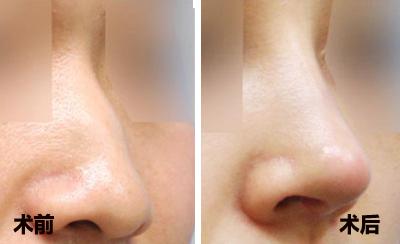 晉中鼻整形手術(shù)失敗修復(fù)醫(yī)生