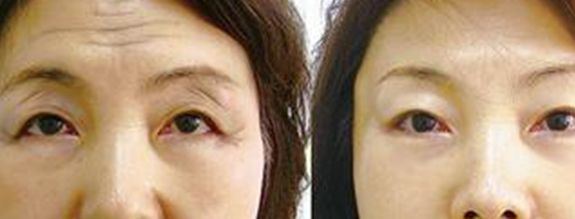 廣州超聲法去眼袋手術(shù)醫(yī)生