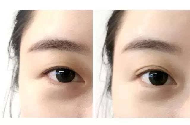 北京針清祛痘印醫(yī)生