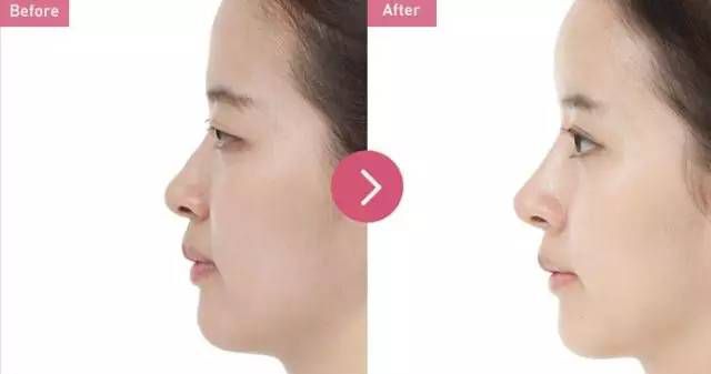 長(zhǎng)沙肉毒素注射魚尾紋醫(yī)生