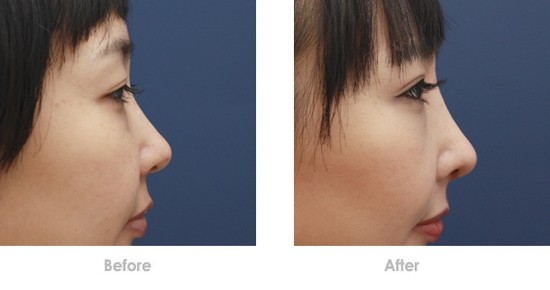 四川痘印點陣激光醫(yī)生