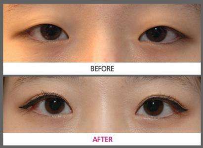 烏魯木齊長(zhǎng)痘點(diǎn)陣激光醫(yī)生