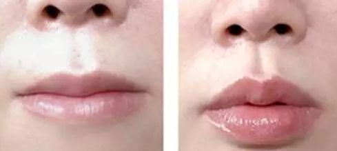 成都超高頻激光去雀斑醫(yī)生