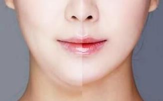 杭州微創(chuàng)額頭紋手術(shù)醫(yī)生