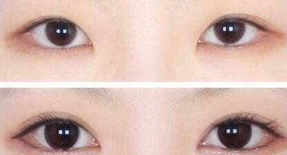 重慶唇紋打肉毒素醫(yī)生