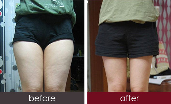 湖州魚(yú)尾紋自體填充醫(yī)生