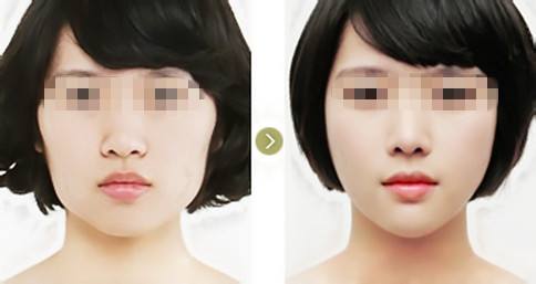 廈門鼻孔開大術(shù)醫(yī)生