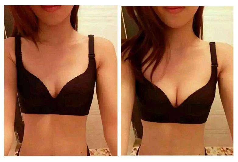 義烏生長(zhǎng)紋填充面部皺紋醫(yī)生