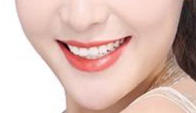 河南玻尿酸唇紋填充醫(yī)生