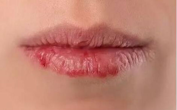 上饒玻尿酸去深度皺紋醫(yī)生