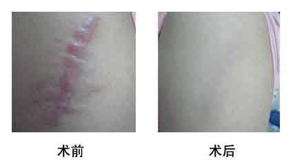 淮北光子點痣醫(yī)生