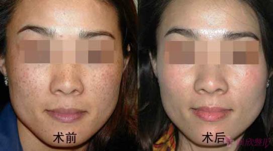 廈門生長紋射頻祛除醫(yī)生