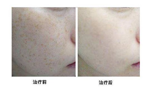 南京鼻部精細(xì)埋線提升醫(yī)生