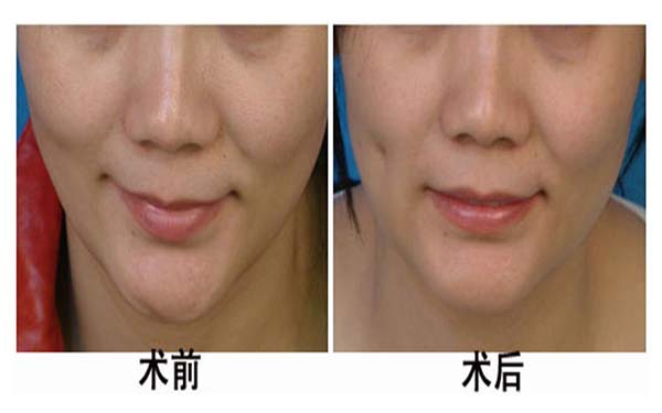 湖州雙眼皮手術(shù)機(jī)構(gòu)推薦：3家優(yōu)質(zhì)醫(yī)院完美整形，放心選擇