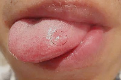 深圳細(xì)胞填充眼袋醫(yī)生