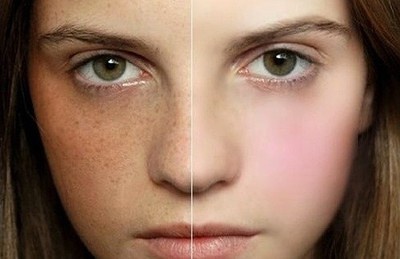 無(wú)錫射頻去木偶紋醫(yī)生