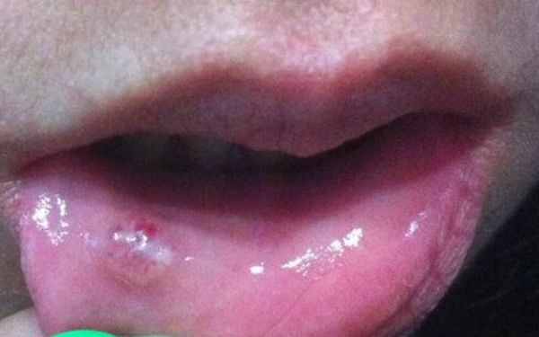 南寧細胞激光去額頭紋醫(yī)生