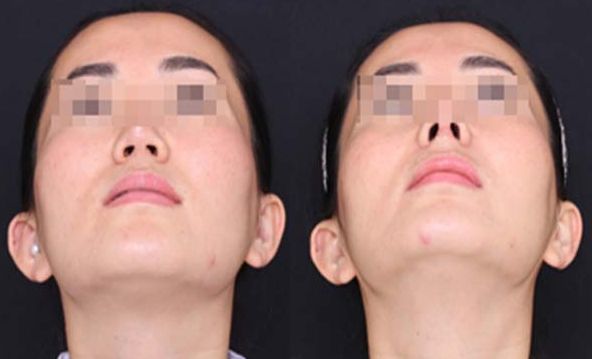 合肥自己的脂肪填充下巴整形醫(yī)院排名前三、前五+費(fèi)用全新一覽!