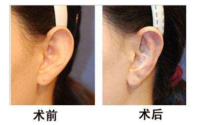 《長春假體隆胸變軟最佳醫(yī)院排名TOP3解析》