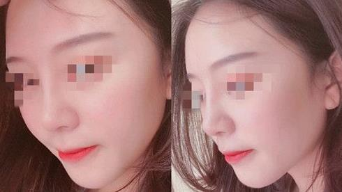耳軟骨隆鼻術(shù)后三個月，我有了韓佳人同款美鼻