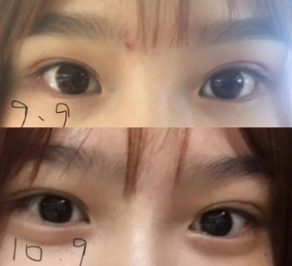 做雙眼皮案例，濟南坤如瑪麗崔金珍雙眼皮案例圖片