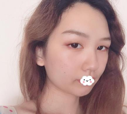 武漢伊萊美割雙眼皮怎么樣？切開雙眼皮恢復過程圖