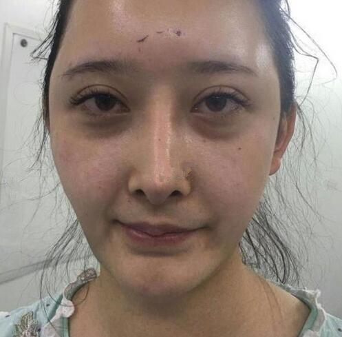 深圳陽光全臉填充術(shù)前效果