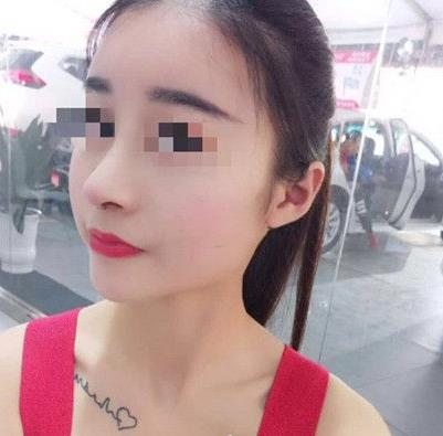 石家莊諾萬整形姚華榮硅膠隆鼻效果分享，同款酒糟鼻值得一試