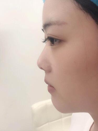 廈門海峽整形鼻綜合案例分享，這鼻子可以滑滑梯了