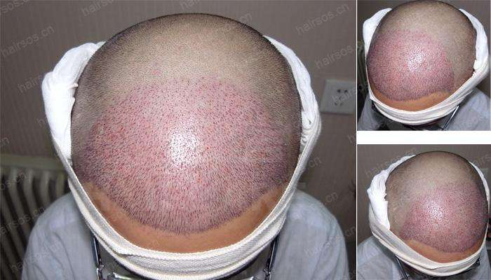 南京美貝爾發(fā)際線種植案例分享，不僅年輕還顯臉小