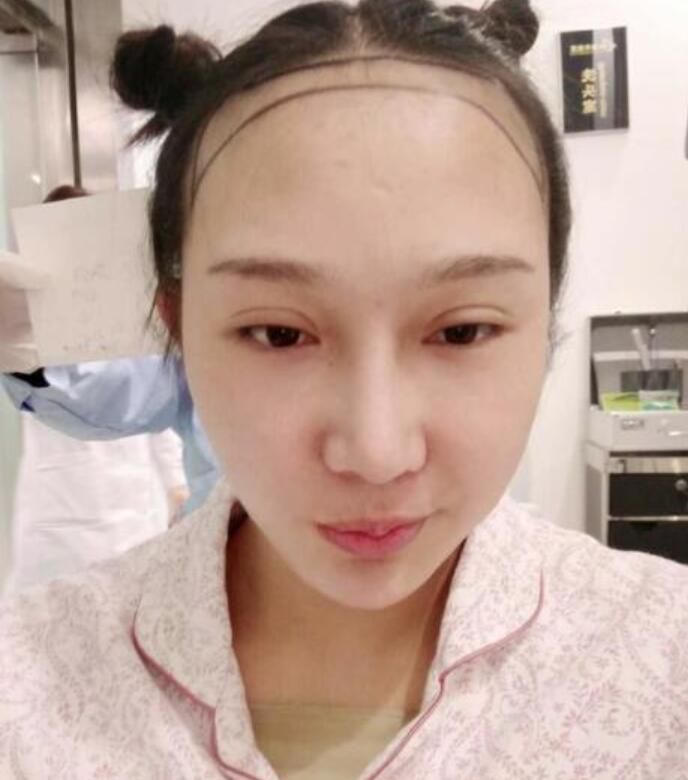 溫州新生植發(fā)種植發(fā)際線案例反饋，與大腦門說拜拜