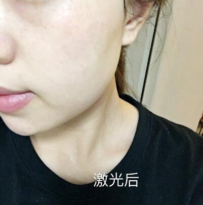 紹興維美整形激光祛斑兩個療程，皮膚像剝了殼的雞蛋