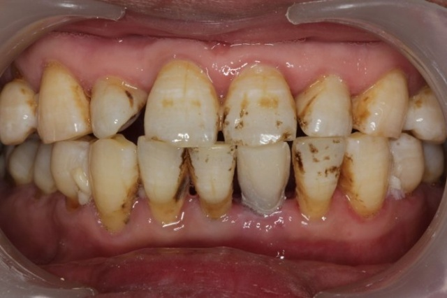 深圳正夫口腔種植牙案例分享，這下可以好好吃飯了