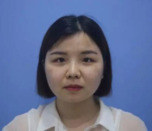 長沙星雅整形激光祛斑三個月效果分享，白白凈凈誰看了不愛