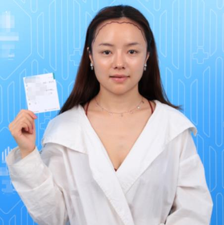 廈門新生植發(fā)種植發(fā)際線半年效果分享，一鍵get高顱頂