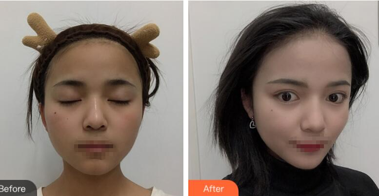 長沙愛思特整形定點雙眼皮案例分享，蘿莉到御姐的轉(zhuǎn)變