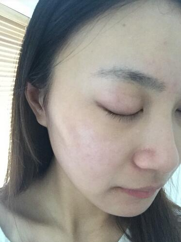 合肥艾雅整形紅藍(lán)光祛痘兩個(gè)療程效果，痘痘都消失了