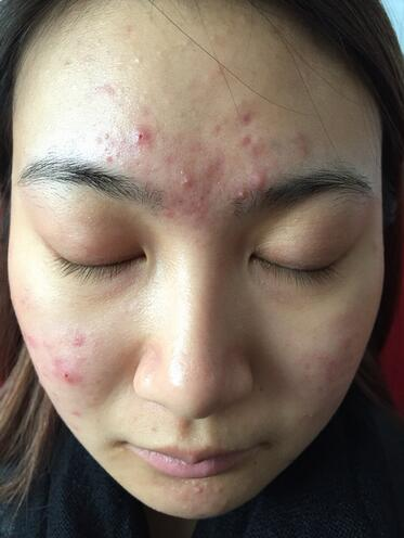 合肥艾雅整形紅藍(lán)光祛痘兩個(gè)療程效果，痘痘都消失了