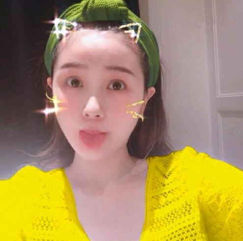 重慶美聯(lián)臣下頜角整形術(shù)后三個(gè)月效果反饋，一定要忌嘴