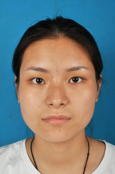 西安國際下頜角整形案例分享，怪不得都說整形要先輪廓后五官